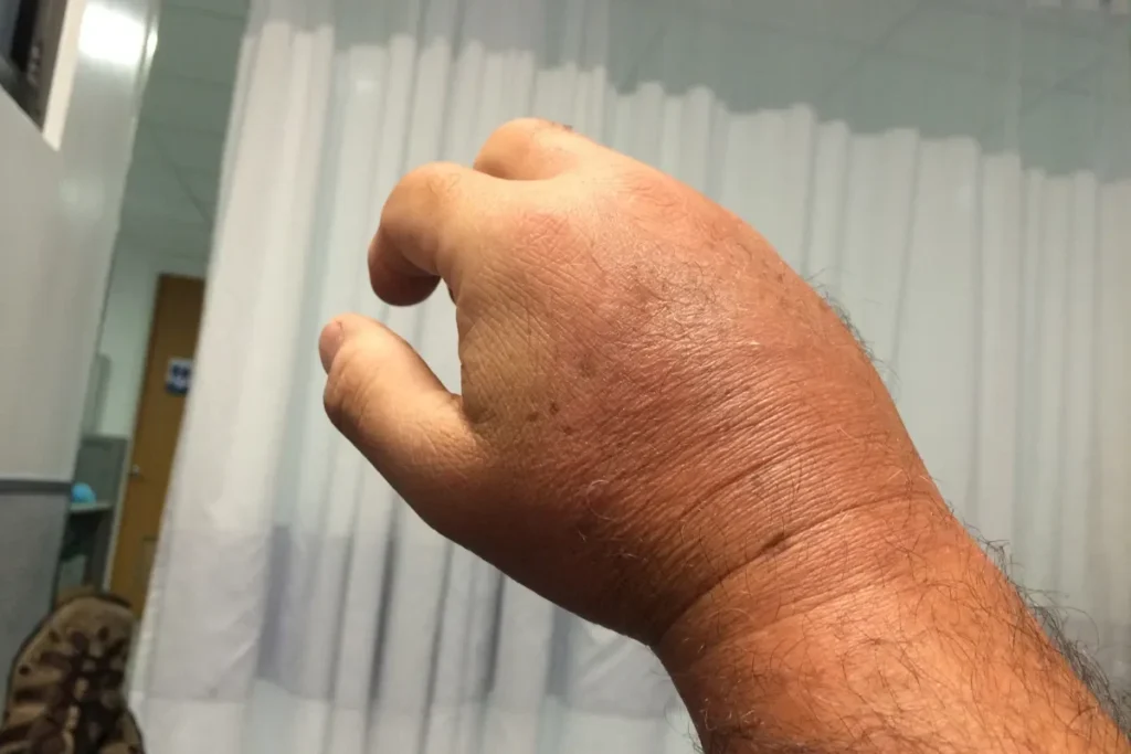 main-et-doigt-gonfle-comprendre-et-soulager