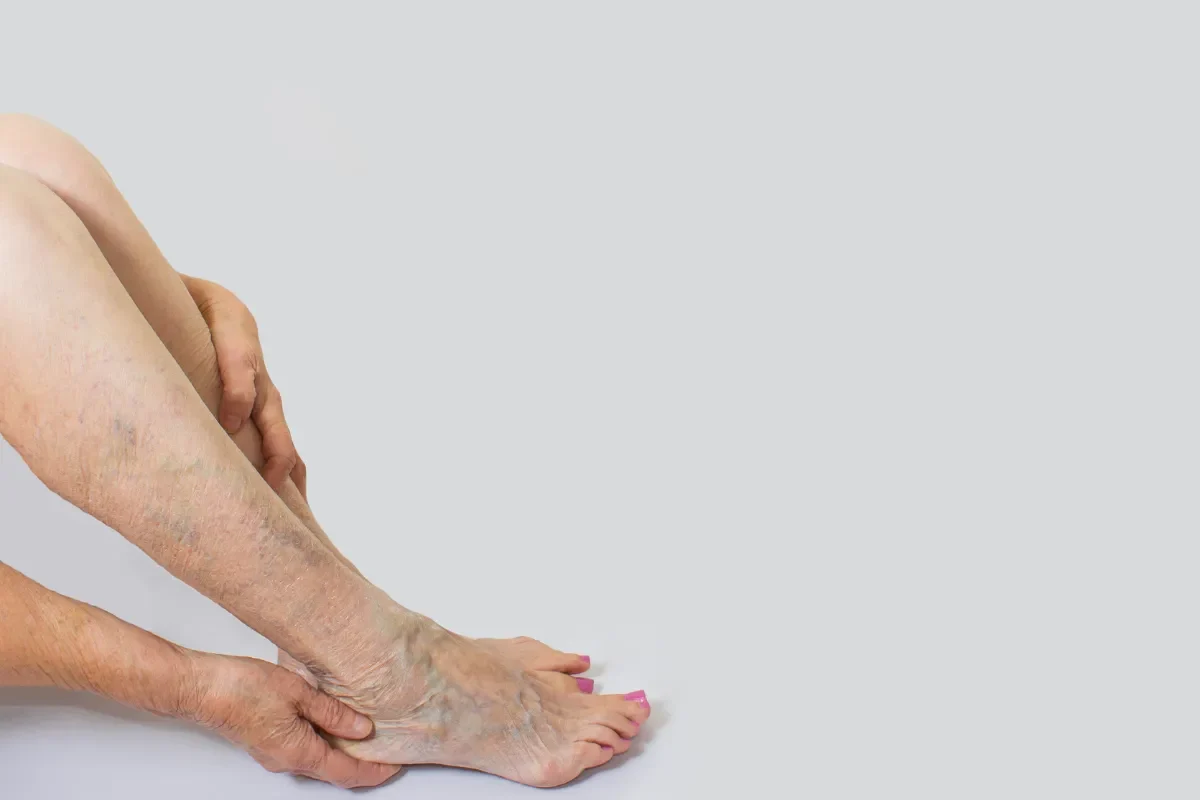 traitement-naturel-pour-les-varices-solutions-efficaces