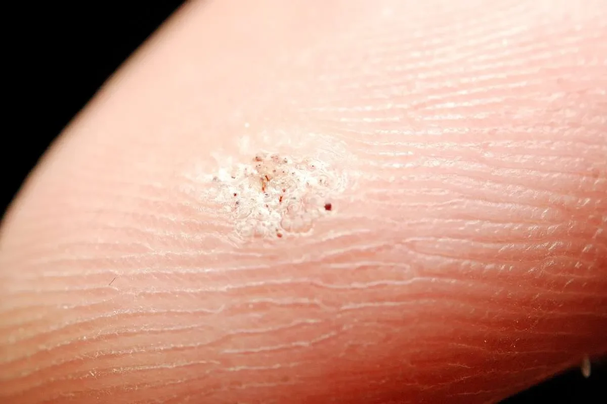 À quoi ressemble une verrue morte ?