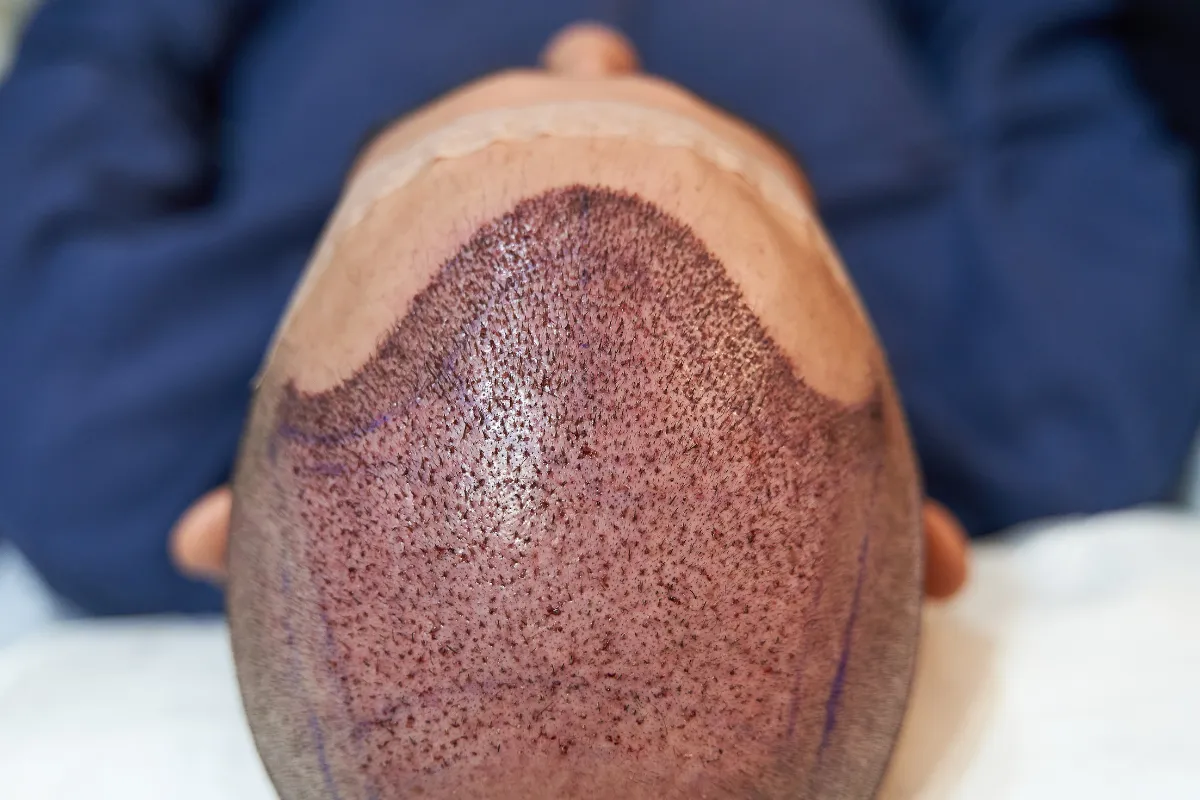 Où faire une greffe de cheveux à Paris