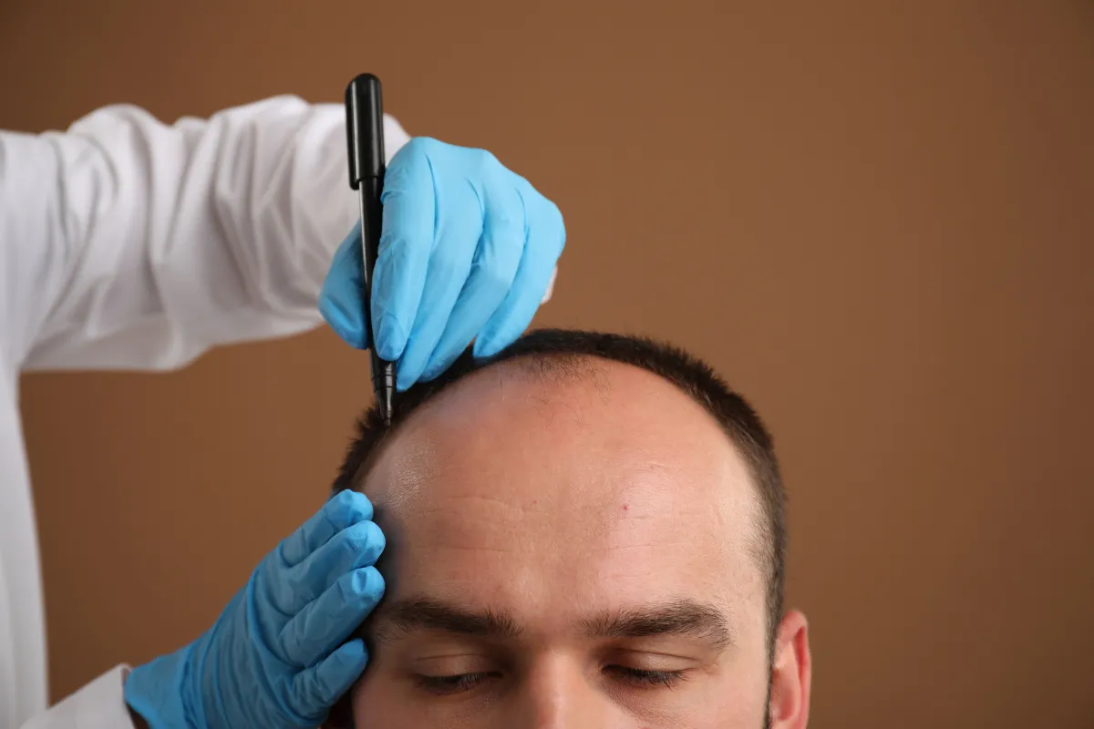 Où faire une greffe de cheveux à Paris